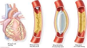 Nhồi máu cơ tim là một thuật ngữ chỉ tình trạng cơ tim bị hoại tử