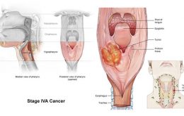 Chẩn đoán xác định ung thư thực quản (tiếp theo)