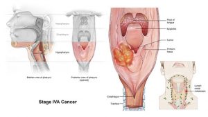 Chẩn đoán xác định ung thư thực quản (tiếp theo)