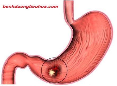 Bệnh Mondor có những triệu chứng gì?
