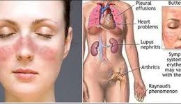 triệu chứng của lupus ban đỏ hệ thống