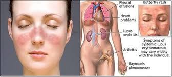 triệu chứng của lupus ban đỏ hệ thống